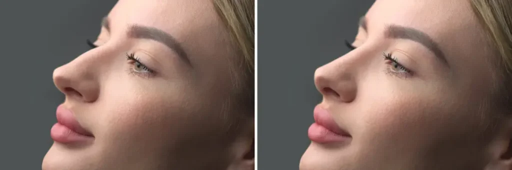 crooked-nose